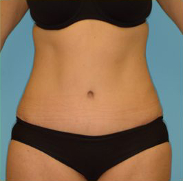 Abdominoplasty Before & After Patient #136