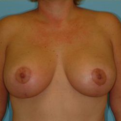 Mastopexy Before & After Patient #763