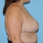 Mastopexy Before & After Patient #811
