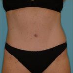 Abdominoplasty Before & After Patient #143