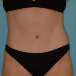 Abdominoplasty Before & After Patient #143