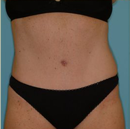 Abdominoplasty Before & After Patient #143