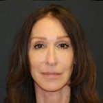 Facelift Before & After Patient #326