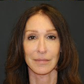 Facelift Before & After Patient #326