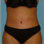 Abdominoplasty Before & After Patient #150