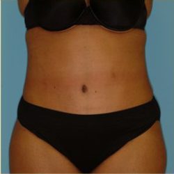 Abdominoplasty Before & After Patient #150