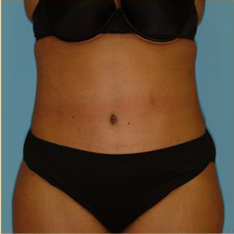 Abdominoplasty Before & After Patient #150
