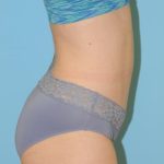 Abdominoplasty Before & After Patient #164