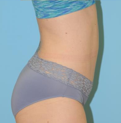 Abdominoplasty Before & After Patient #164