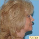 Facelift Before & After Patient #171