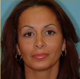 Blepharoplasty Before & After Patient #178
