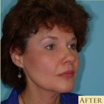 Blepharoplasty Before & After Patient #185