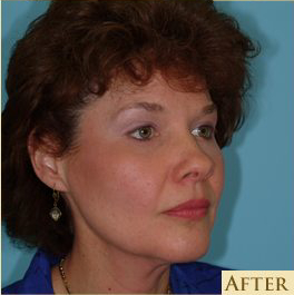 Blepharoplasty Before & After Patient #185