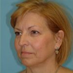 Blepharoplasty Before & After Patient #192