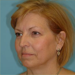 Blepharoplasty Before & After Patient #192