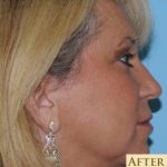 Blepharoplasty Before & After Patient #199