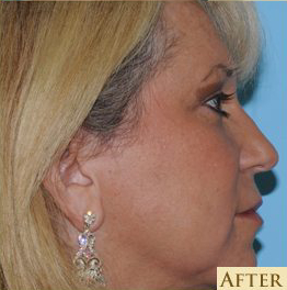 Blepharoplasty Before & After Patient #199
