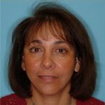 Facelift Before & After Patient #206