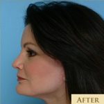 Blepharoplasty Before & After Patient #2770