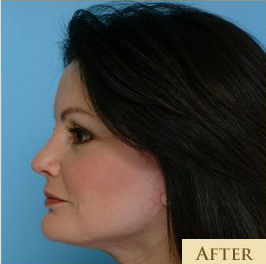 Facelift Before & After Patient #213
