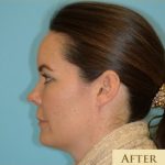 Blepharoplasty Before & After Patient #221