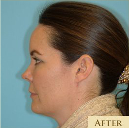 Blepharoplasty Before & After Patient #221