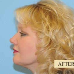 Facelift Before & After Patient #228