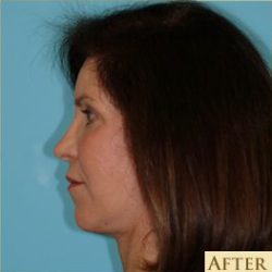 Facelift Before & After Patient #235