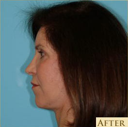 Facelift Before & After Patient #235