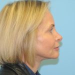 Facelift Before & After Patient #242