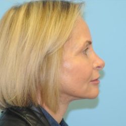 Facelift Before & After Patient #242