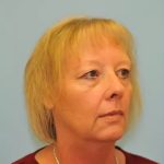 Facelift Before & After Patient #256