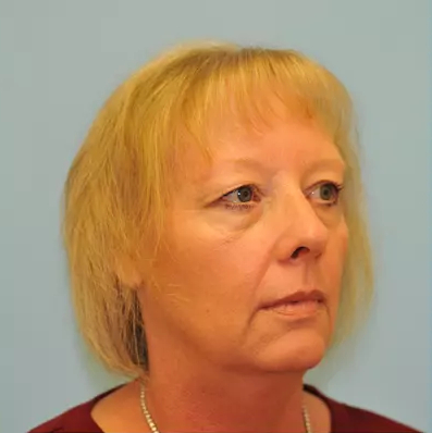 Facelift Before & After Patient #256