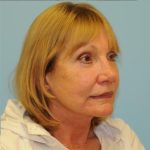 Facelift Before & After Patient #263