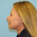Facelift Before & After Patient #2766