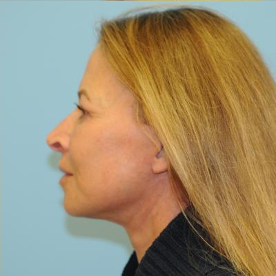 Facelift Before & After Patient #270