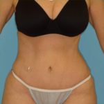 Abdominoplasty Before & After Patient #87