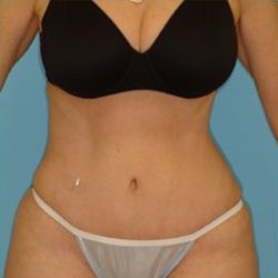 Abdominoplasty Before & After Patient #87