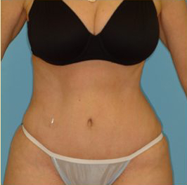 Abdominoplasty Before & After Patient #87
