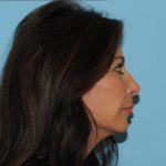 Facelift Before & After Patient #277