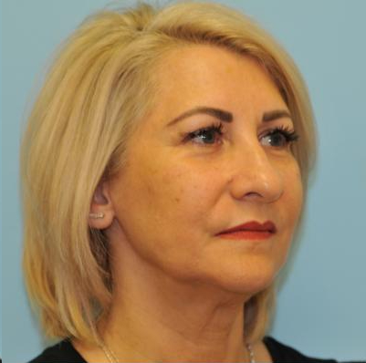 Facelift Before & After Patient #284