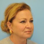 Facelift Before & After Patient #291