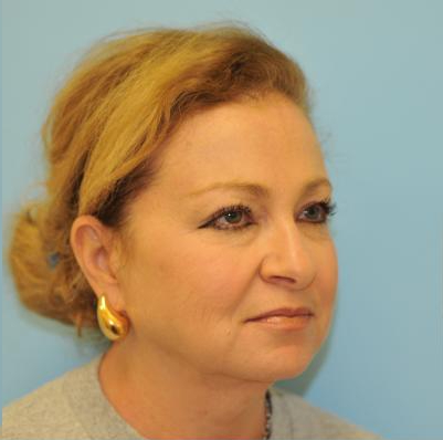 Facelift Before & After Patient #291