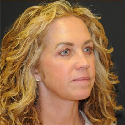 Blepharoplasty Before & After Patient #312