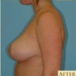 Breast Reduction Before & After Patient #333