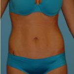 Abdominoplasty Before & After Patient #94