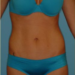 Abdominoplasty Before & After Patient #94