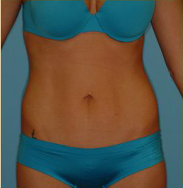 Abdominoplasty Before & After Patient #94