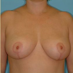 Breast Reduction Before & After Patient #347