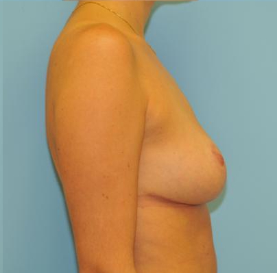 Breast Reduction Before & After Patient #368